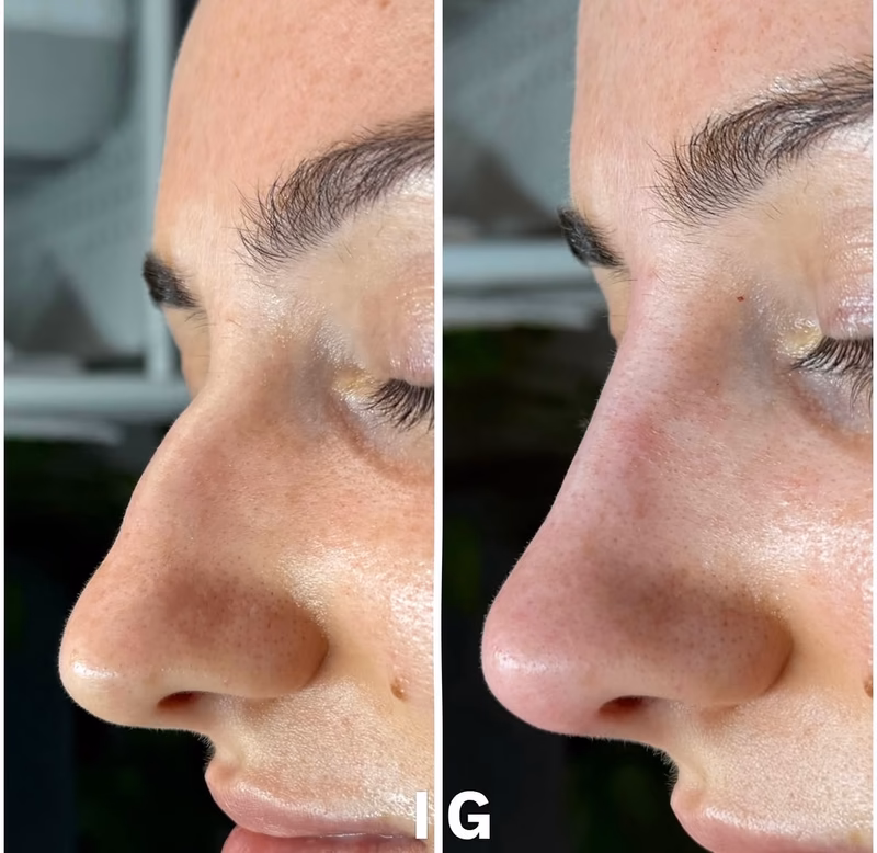 Before and after comparison: Non-Surgical Rhinoplasty, Nose