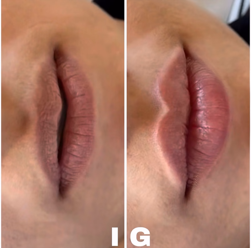 Before and after comparison: Lip Filler, Lips